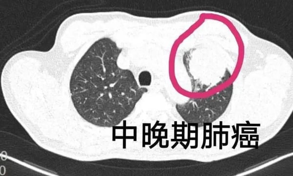 能杀死所有实体癌瘤的新药又被媒体研发出来了