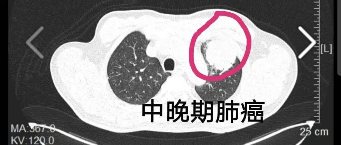 能杀死所有实体癌瘤的新药又被媒体研发出来了