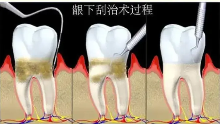 An image to describe post 看个牙龈出血花掉几千块，我是不是被坑了？