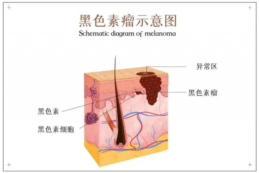 An image to describe post 一种能肉眼自查发现的癌症，请一定不要忽视这些征兆